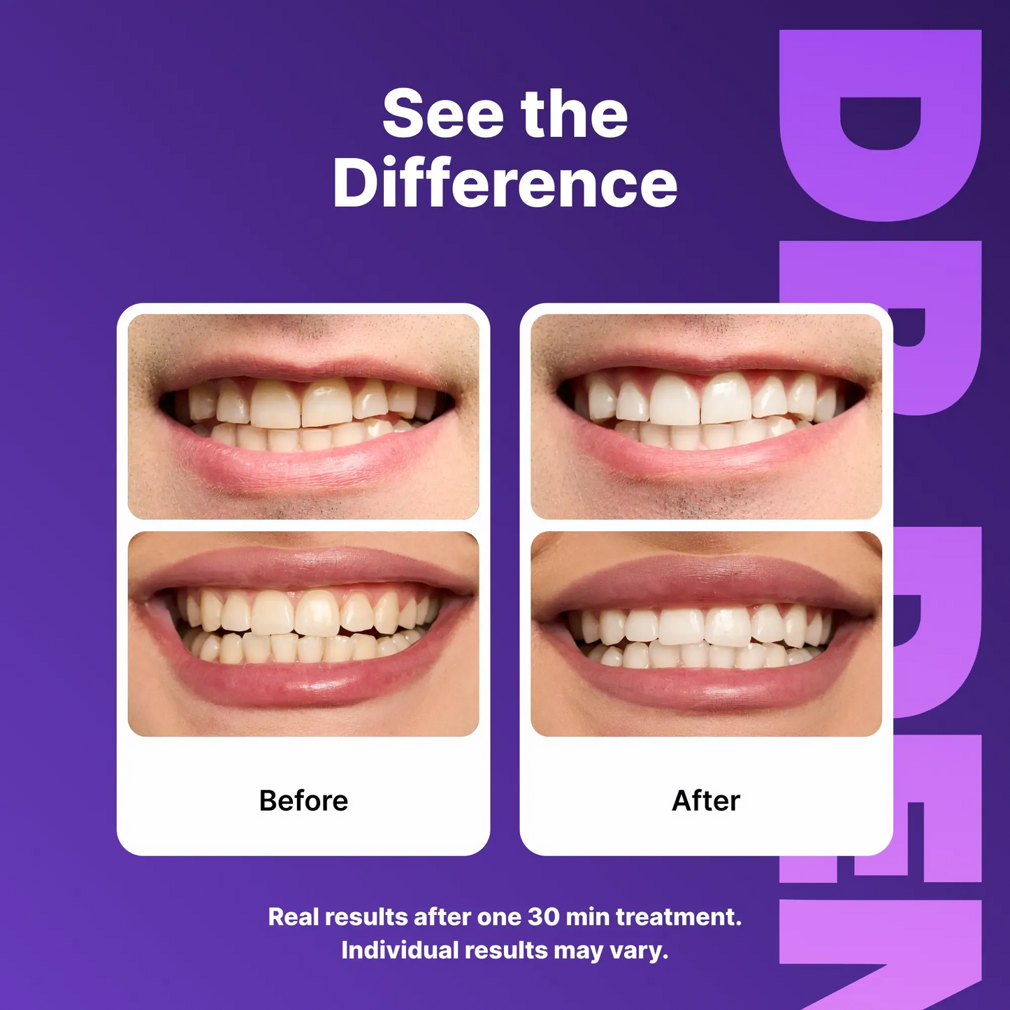 Purple Teeth Whitening Strips - 7/21 Whitening Sessions - Non Sensitive Teeth Whitening - Peroxide-Free